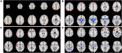Transcranial direct current stimulation of the occipital lobes with adjunct lithium attenuates the progression of cognitive impairment in patients with first episode schizophrenia